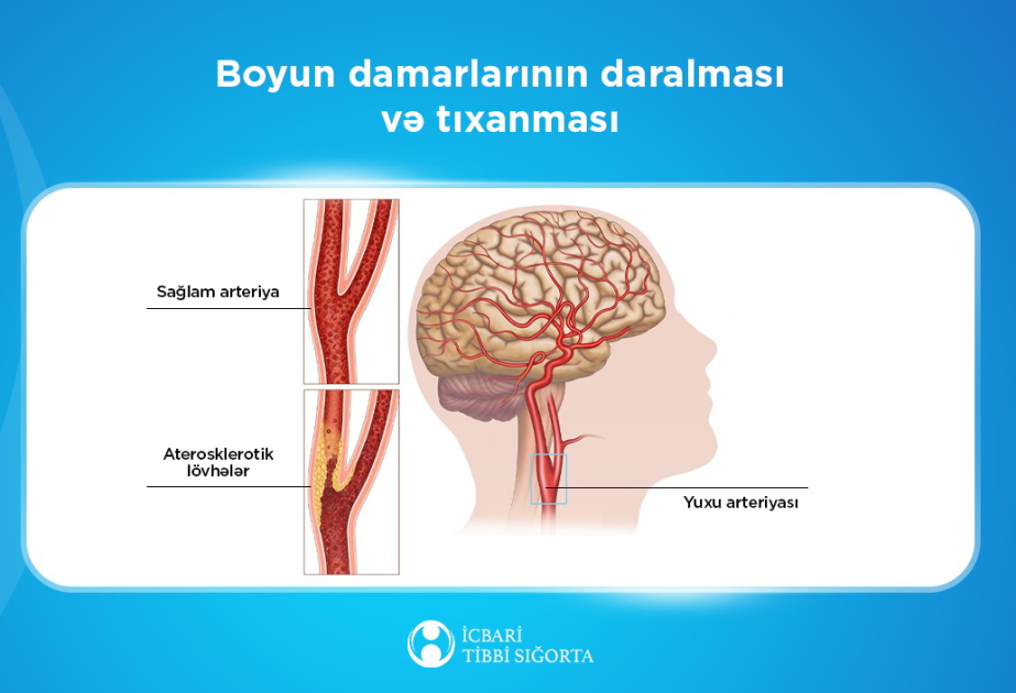 Agentlik: Beyin qan dövranı pozulmalarının müayinə və müalicəsi icbari tibbi sığorta təminatına daxildir